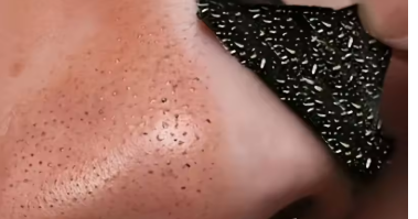 Black Mask – Máscara Preta Pontos Negros e Acne